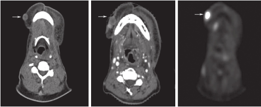 图1 右侧下颌体右前份皮下软组织结节影（平扫CT，增强CT和PET-CT）
